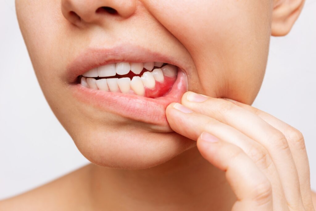 Hambakatt ja hambakivi– kuidas need seotud on?